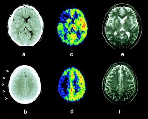 Early X Ray Hypoattenuation Of Brain Parenchyma Indicates Extended