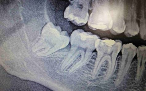 Caso clínico extracción del tercer molar o muela del juicio