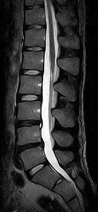 Bandscheibenabnutzung Symptome Therapie Operation