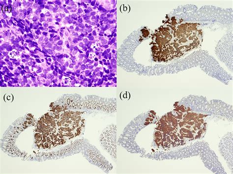 Hematoxylineosin Staining And Immunohistochemistry Of Cold Snare