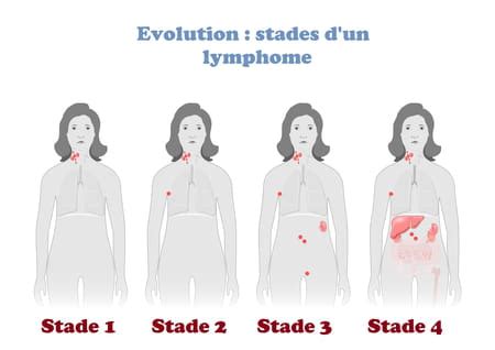 Sympt Mes D Alerte D Un Lymphome