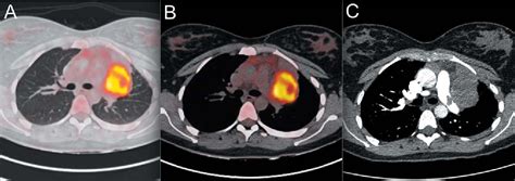 Biphasic Pulmonary Blastoma Semantic Scholar