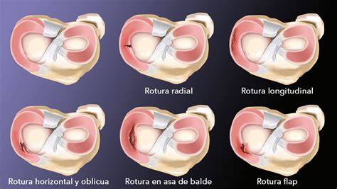 Lesión de Menisco TMR Buenos Aires