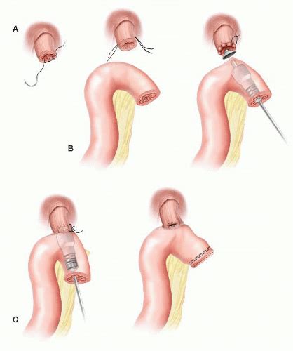 Total Gastrectomy for Cancer | Basicmedical Key