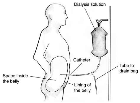 Man Receiving Peritoneal Dialysis With Labels For The Dialysis Solution Catheter Space Inside