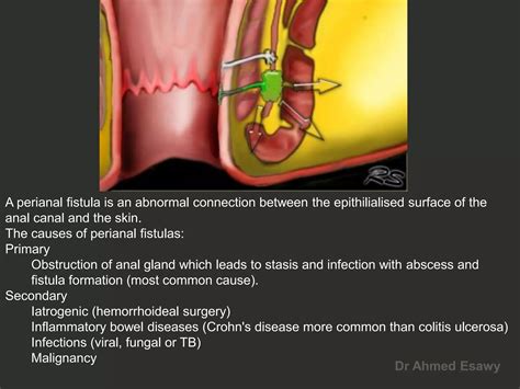Anal Perianal Imaging Part Perianal Fistula CT MRI Dr Ahmed Esawy PDF