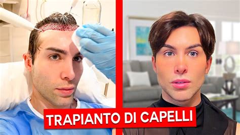 Trapianto Di Capelli La Mia Esperienza Gianmarco Zagato Youtube