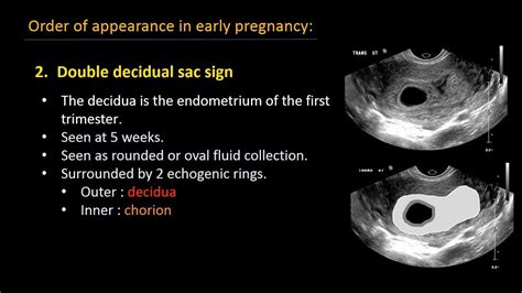 Ultrasound Of Normal Early Pregnancy Youtube