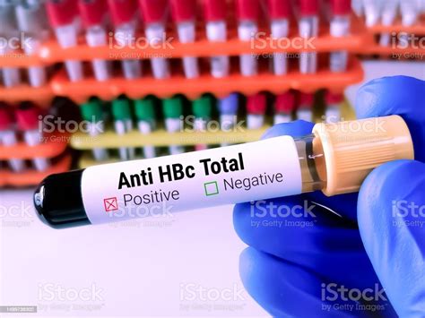 Anti Hbc Total Test Acute Hepatitis B Infection Stock Photo - Download ...