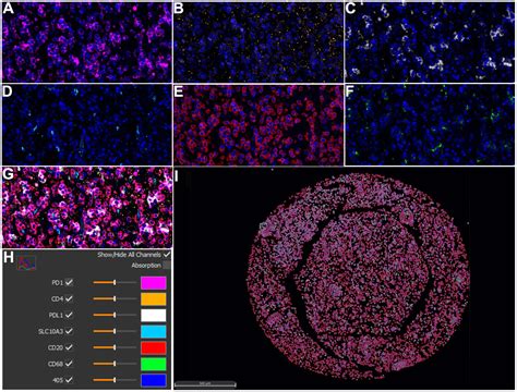 The Prognostic Significance And Immune Correlation Of Slc A In Low