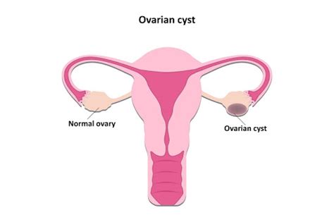 Ovarian Cysts What They Mean For Your Fertility Cool Springs Obgyn