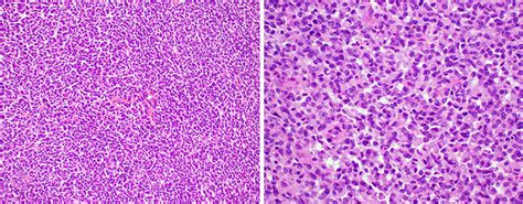 Histopathological Features Of Mediastinal Synovial Sarcoma Poorly