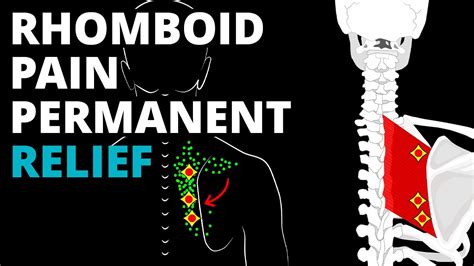 How To Fix Rhomboid Pain Permanently Corrective Exercises Stretches