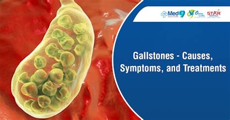 Dr T Lakshmikanth What Problems Do Gallstones Cause Gallstones Causes Symptoms And