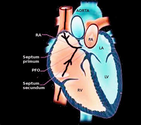 [figure Patent Foramen Ovale Image Courtesy O Chaigasame