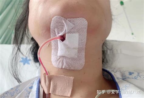 甲状腺腔镜手术——不可不知的手术方式选择、术后恢复及注意事项 知乎