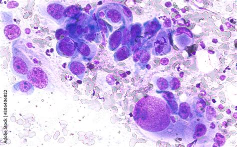 Phogomicrograph Of Fine Needle Aspiration Fna Cytology Of A Pulmonary