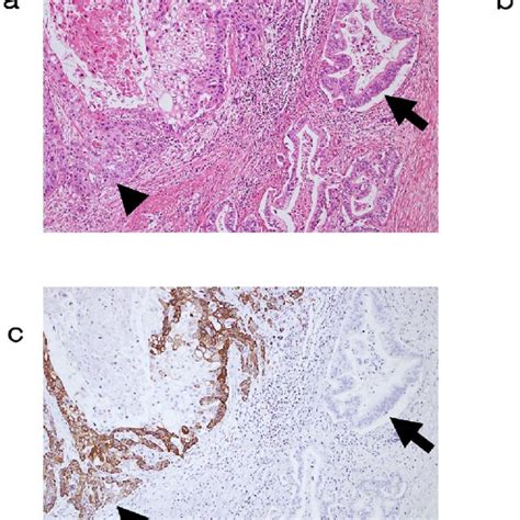 He Staining Of Adenosquamous Carcinoma A The Adenocarcinoma Download Scientific Diagram