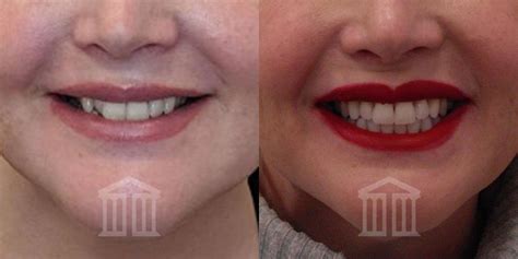 Invisalign Treatment Nottingham Zenith Cosmetic Dental