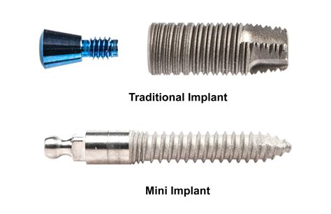 Types of Dental Implants Explained | Aspire Dental Group