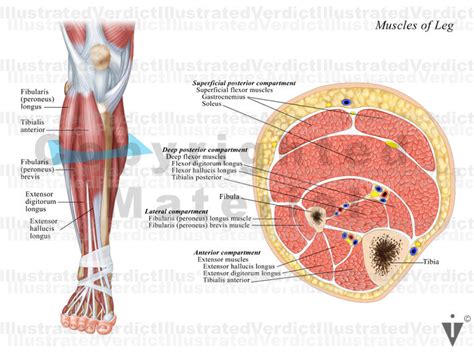 Stock Lower Limb Compartment Syndrome Illustrated Verdict