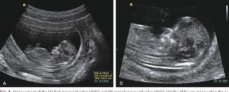 Figure From Simplified Protocol Of Nuchal Translucency Measurement