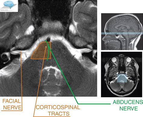 Midbrain Pons And Medulla Anatomy And Syndromes Radiographics