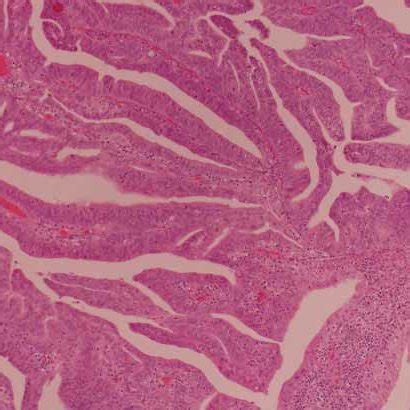 Cervical Cytology Smear Of Villoglandular Papillary Adenocarcinoma