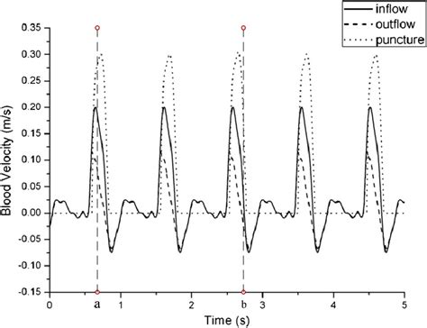 Comparison Of Velocity Waveforms Of Inflow Outflow And The Puncture