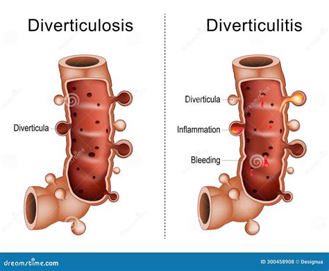 Difference Between Diverticulitis And Diverticulosis Vector