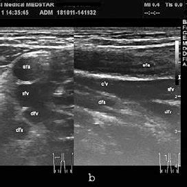 B Mode Image Of The Femoral Vessels Within The Right Femoral Triangle