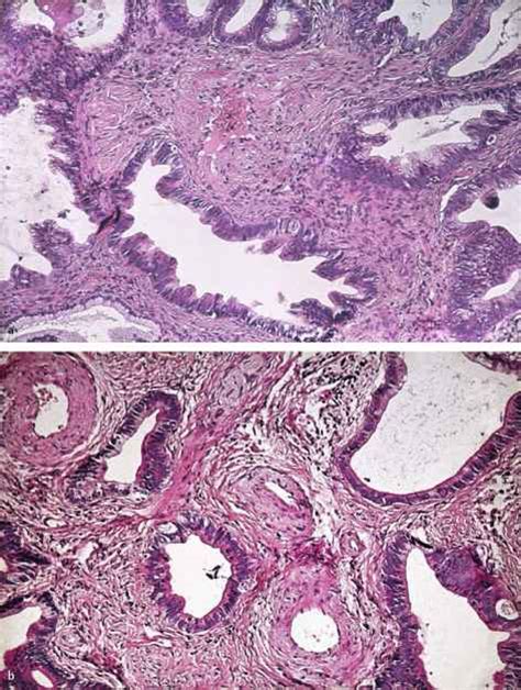 Mucinous Adenocarcinoma [84803 - Cell Differentiation