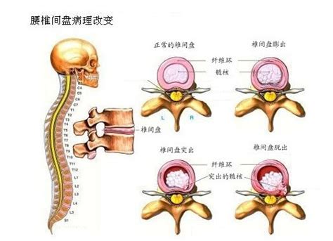 腰椎压迫神经好治吗 腰椎盘压迫神经怎么办 随意云