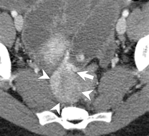 Ct For Evaluation Of Acute Gastrointestinal Bleeding Radiographics