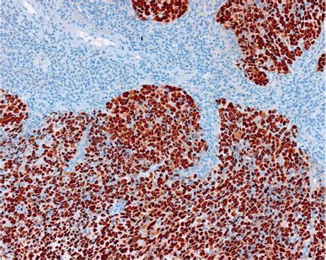 Eber In Situ Hybridization Of Epstein Barr Virus Associated Download Scientific Diagram