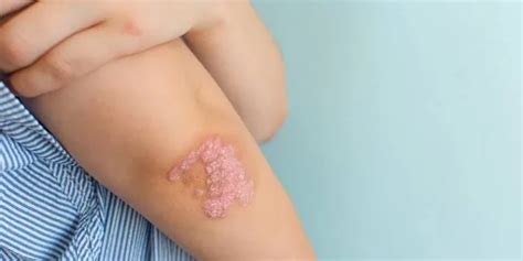 Mengenal Psoriasis: Penyakit Kulit Autoimun yang Perlu Dipahami