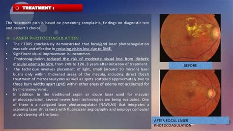 Diabetic Macular Edema (Surgery presentation)