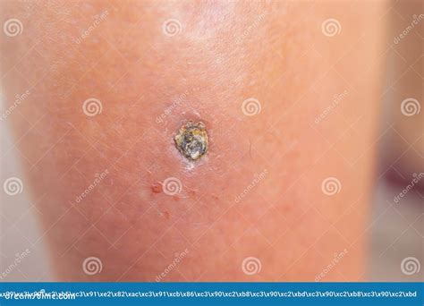 Pimple Folliculitis On Buttock Caused By Infection From Bacteria Yeast