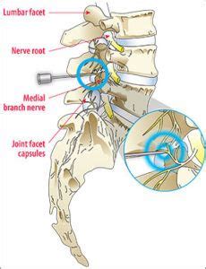 Burning Away Back Pain with Radiofrequency Ablation - Arthritis Advisor