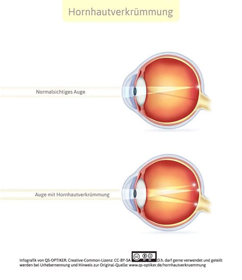 Hornhautverkrümmung Astigmatismus QS OPTIKER