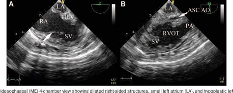 Intraoperative Transesophageal Echocardiography In The Norwood Sano Palliation Of Hypoplastic