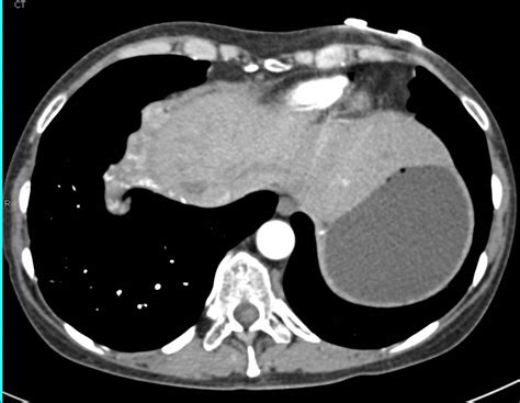 Metastatic Carcinoid Tumor To The Liver With Vascular Metastases