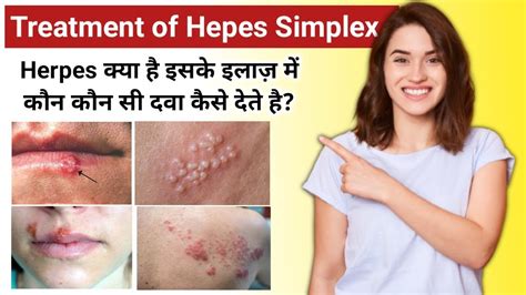 Herpes Simplex Kya Hai Treatment Of Herpes Simplex Acyclovir 400mg