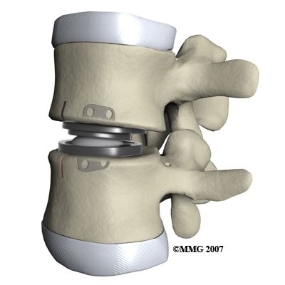 Physical Therapy In Cincinnati And West Chester For Back Lumbar Disc