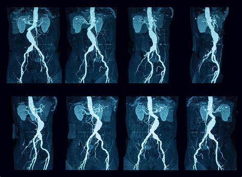 Renal Angiography