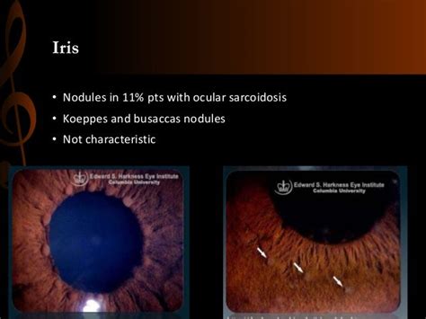 ocular Sarcoidosis