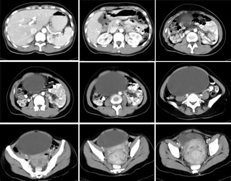 Ovarian Serous Cystadenoma Radiology Cases