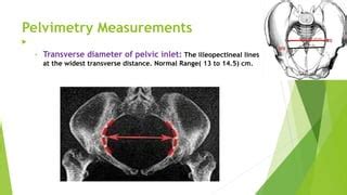 Pelvimetry | PPT