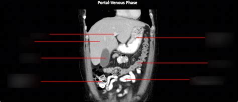 abdomen ct coronal  diagram quizlet
