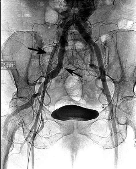 Figure From Management Of The Persistent Sciatic Artery With